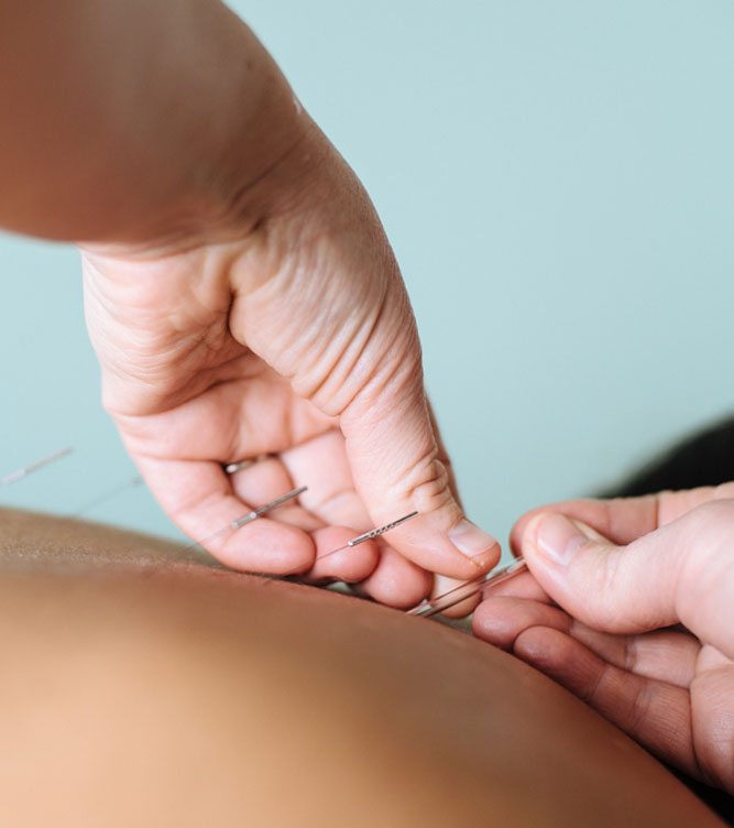 Acupuncture Clinic in Macleod Melbourne Victoria - Acupuncturist