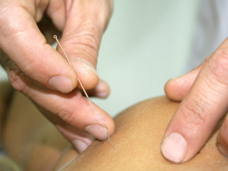 acupuncture