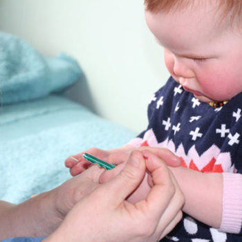 toddler having an acupuncture in macleod victoria australia